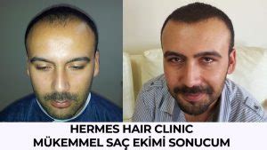 hermes hair clinic saç ekim merkezi|saç ekim merkezi istanbul.